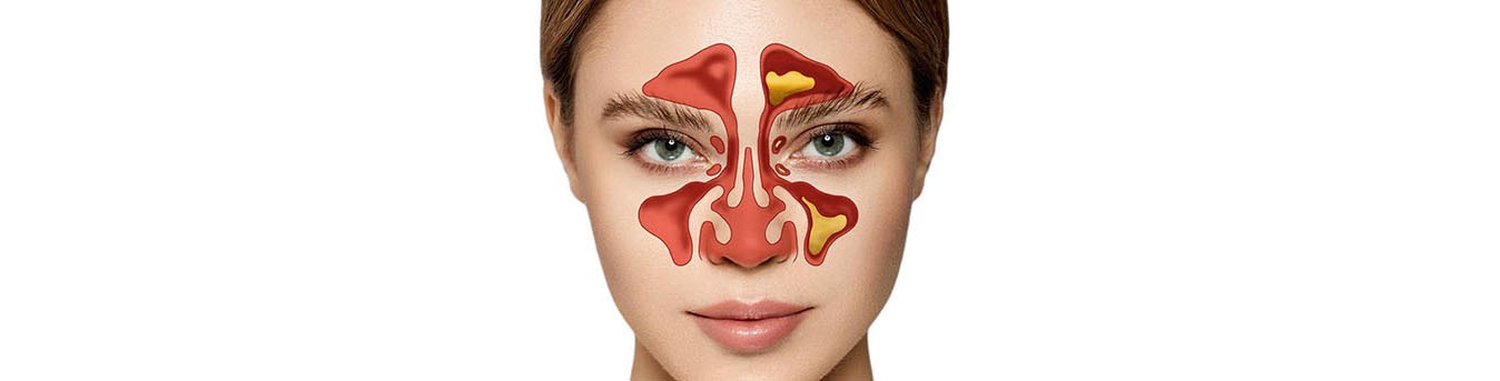 Sinusitis